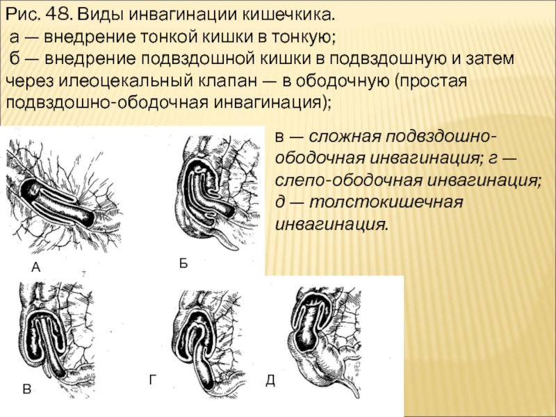 Инвагинация клиническая картина