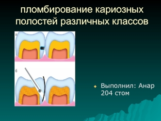 Пломбирование кариозных полостей различных классов