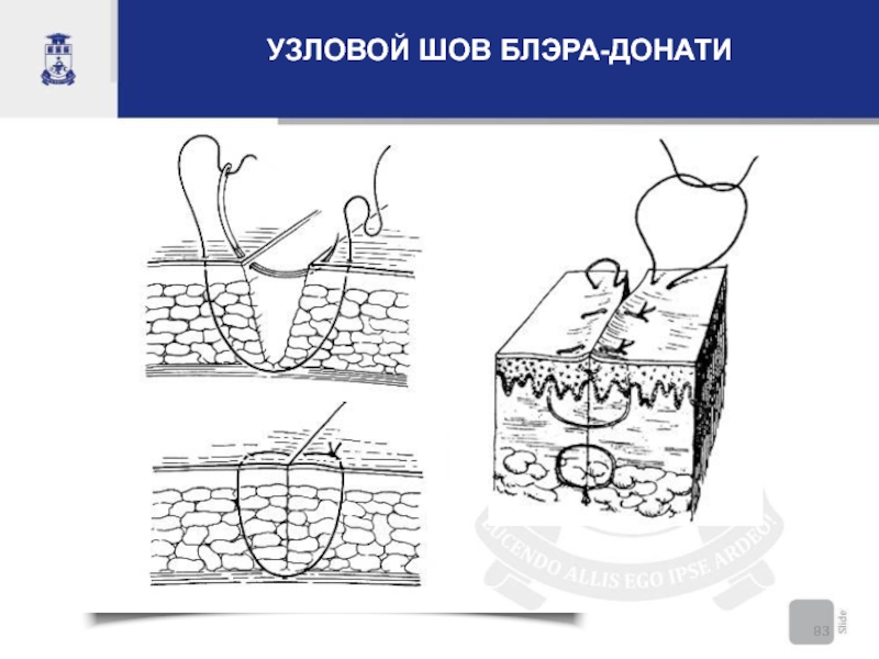 Шов донати схема