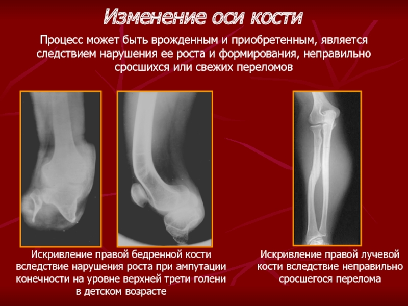 Понял кость. Неправильно сросшийся перелом большеберцовой кости. Неправильное сращение перелома. Неправильно сросшийся перелом лучевой кости. Неправильное сращение лучевой кости.