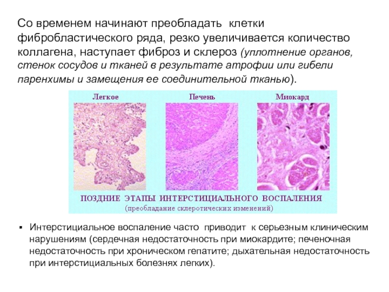 Болезнь коллагена. Склероз и фиброз отличия. Отличие фиброза от склероза. Склероз патологическая анатомия.