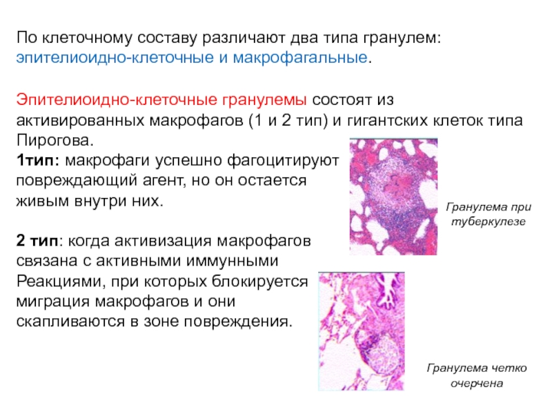 Макрофаги 1 2. Эпителиоидные клетки функции. Эпителиоидно клеточная гранулема. Клеточный состав гранулемы. Макрофаги гистология.