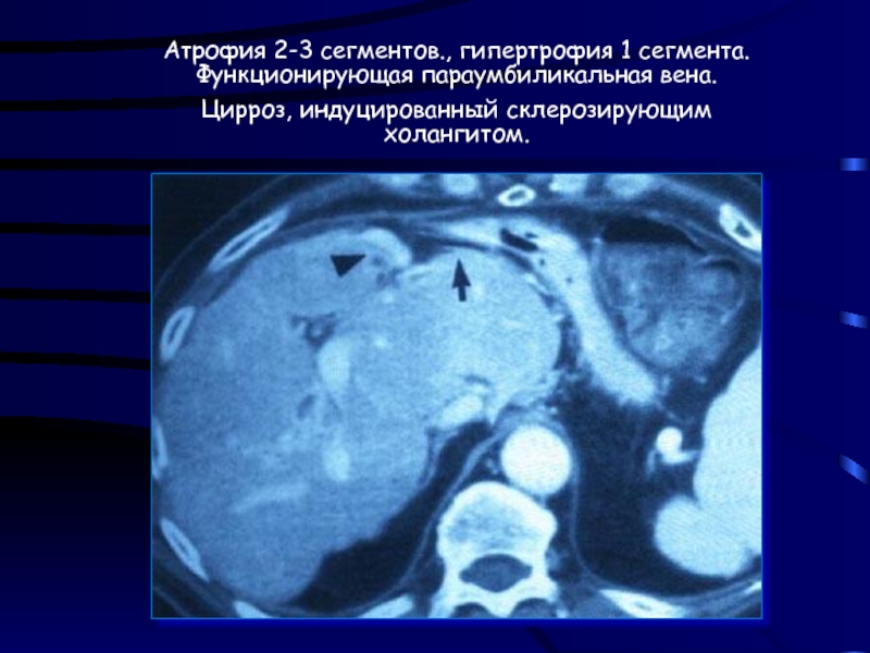 Цирроз печени сколько осталось. Гипертрофия 1 сегмента печени. Кардиоцирроз печени последней стадии. Последняя стадия цирроза печени симптомы.