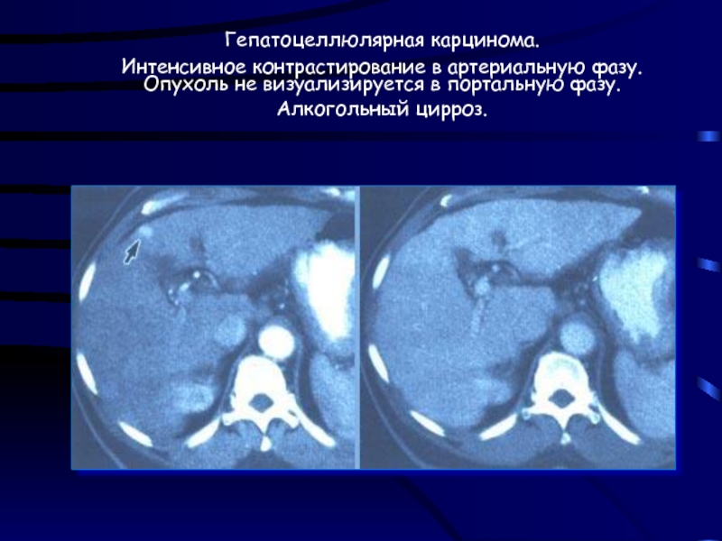 Гцр печени. Гепатоцеллюлярная карцинома кт картина. Гепатоцеллюлярная карцинома печени кт. Гепатоцеллюлярная карцинома мрт.