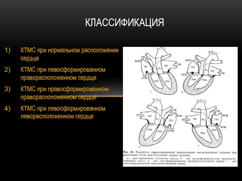 Нормальное расположение. Корригированная транспозиция магистральных сосудов. Правосформированное праворасположенное сердце. Левосформированное леворасположенное сердце. Правосформированное леворасположенное сердце у ребенка.