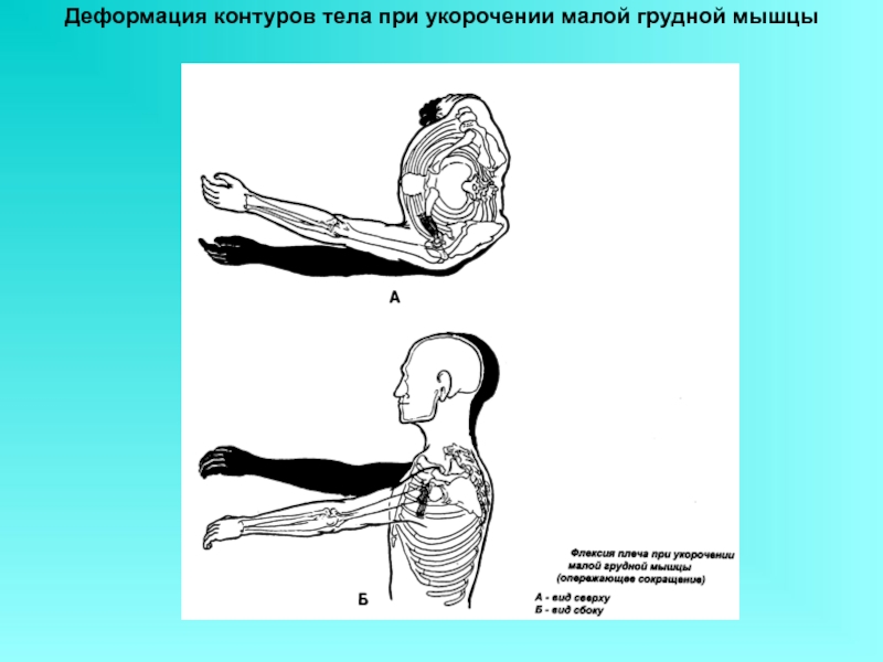 Передняя поверхность туловища. Укорочение малой грудной мышцы. Деформация контуров тела. Деформация контуров тела при укорочении. Укороченные грудные мышцы.