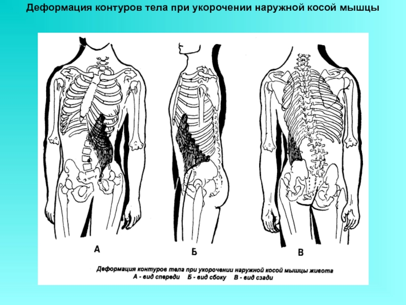 Косое туловище. Укорочение косых мышц живота. Деформация контуров тела. Укороченная косая мышца живота. Укорочение косой мышцы живота.