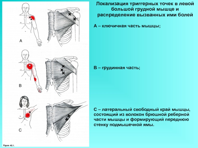 Точка в левом. Триггерные точки грудинная части большой грудной мышцы. Большая грудная мышца латеральный край. Триггерные точки в грудной мышце. Большая грудная мышца Ключичная часть.