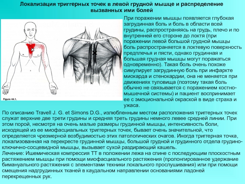 Триггерные точки на теле человека фото с описанием для снятия боли в плече