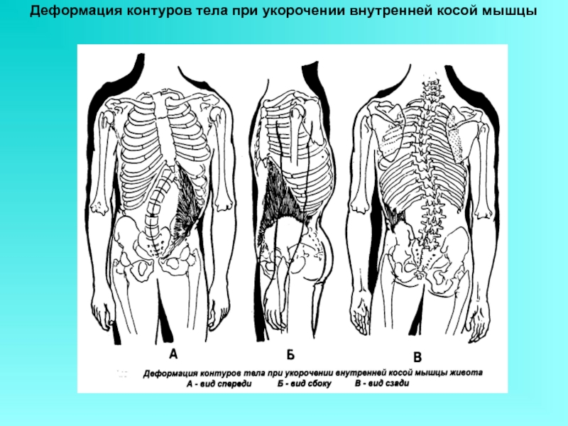 Косое туловище. Укороченная косая мышца живота. Укорочение косой мышцы живота. Деформация контуров. Укорочение косых мышц живота.