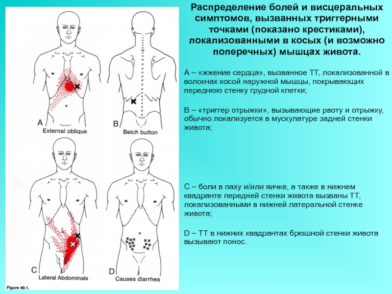 Карта триггерных точек человека и отраженных болей