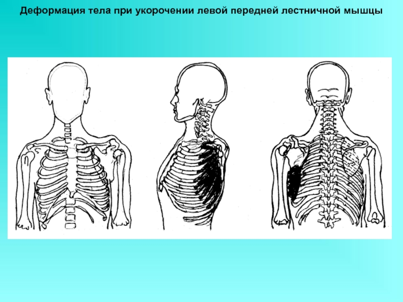 Поверхности туловища. Укорочение лестничных мышц. Лестничные мышцы шеи укоротились. Лестничная трапециевидная мышца. Укороченная лестничная мышца.