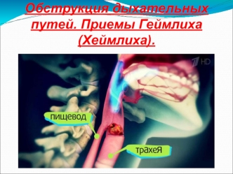 Обструкция дыхательных путей. Приемы Геймлиха (Хеймлиха)