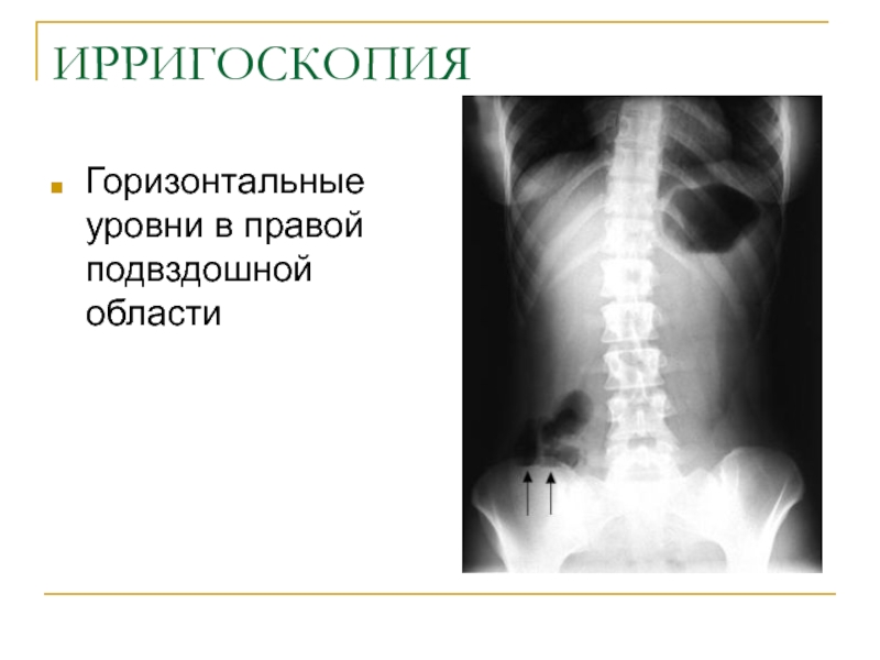 Правая подвздошная область фото