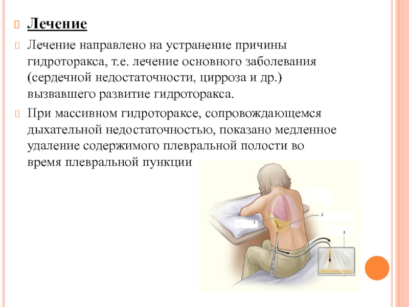 Гидроторакс карта смп