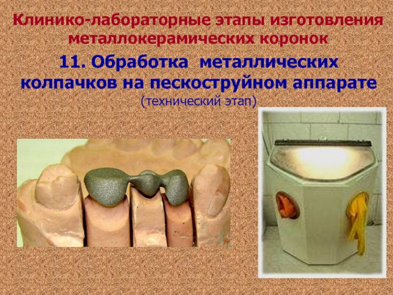 Лабораторные этапы. Обработка каркаса металлокерамического протеза. Этапы изготовления металлокерамической коронки. Клинико лабораторные этапы изготовления металлокерамики. Лабораторные этапы изготовления коронок.