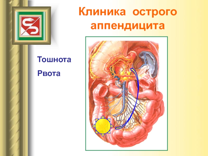 Карта вызова острый аппендицит