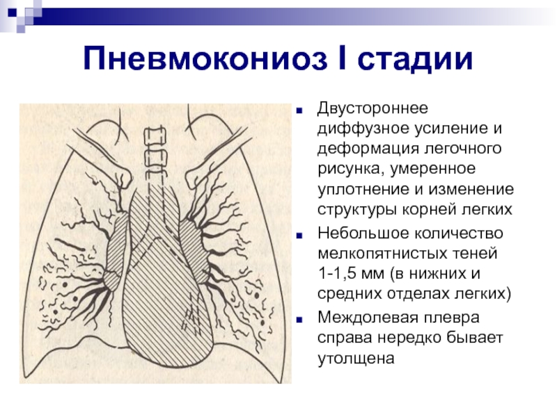 Уплотнен бронхососудистого рисунка