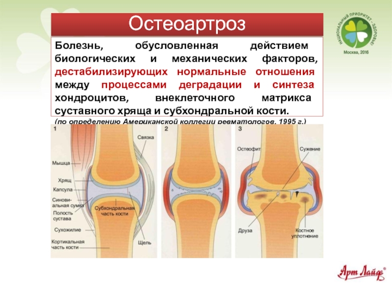 Остеоартроз карта вызова