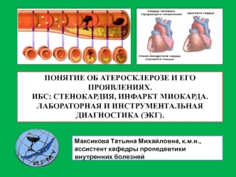 Атеросклероз и его проявления