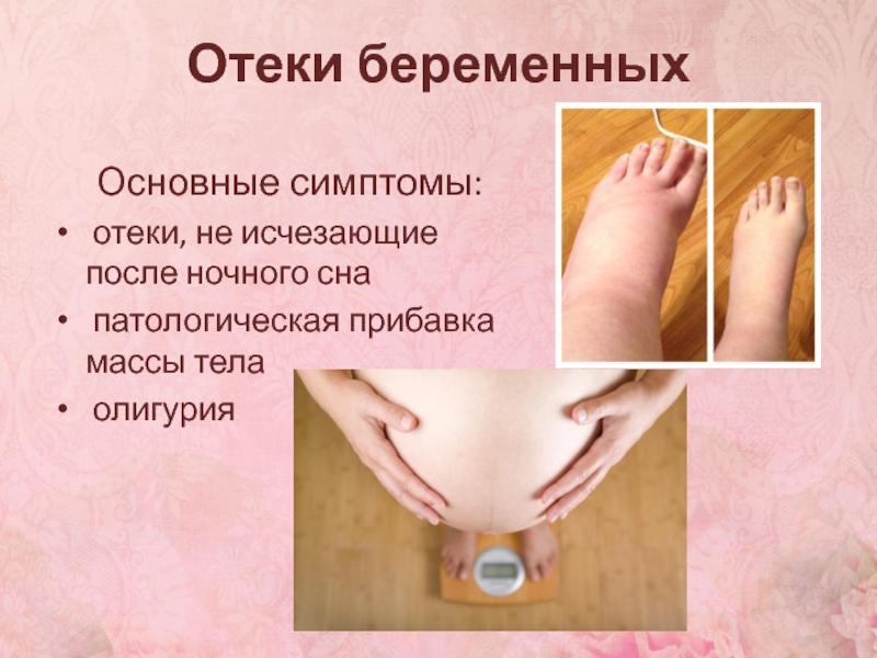 Отеки ног при беременности фото