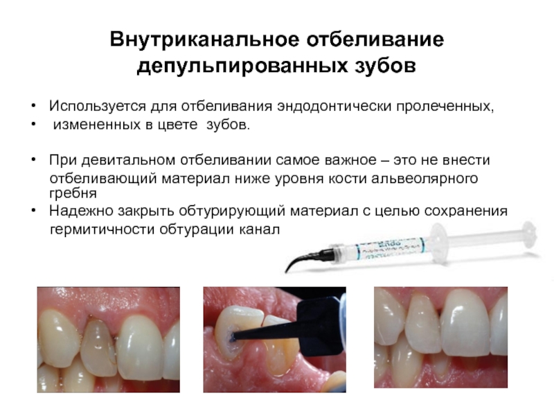 Внутриканальное отбеливание зуба все свои зубная щетка care dental