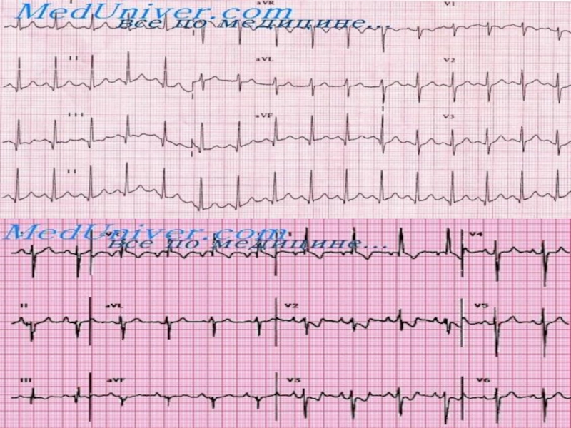 Особенности экг. Atrial tachycardia. Focal Atrial tachycardia. Narrow QRS Complex. Intra Atrial ECG lead.