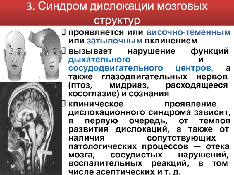 Синдром головного мозга. Синдром дислокации мозговых структур. Отечно дислокационный синдром. Латеральный дислокационный синдром. Отек головного мозга дислокационный синдром.