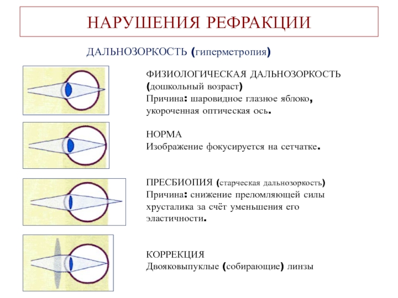 Гиперметропия глаза что это такое