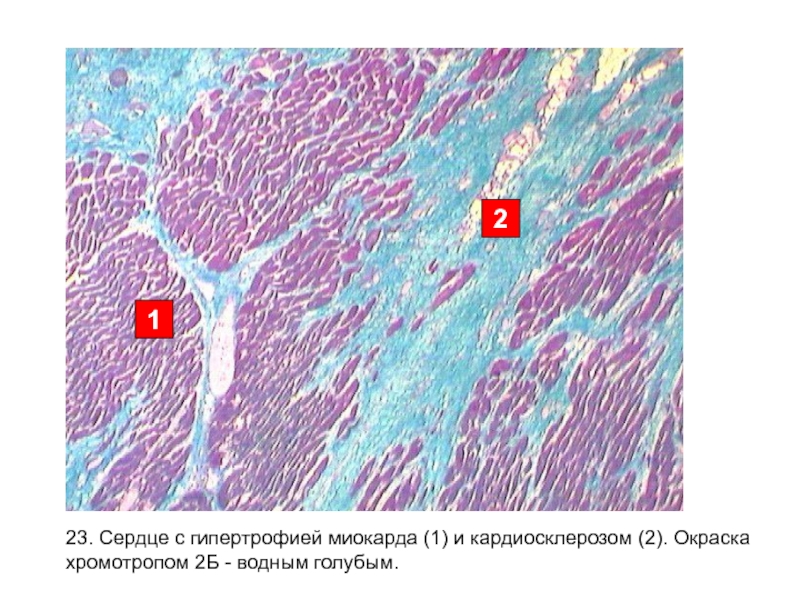 Кардиосклероз рисунок микропрепарат