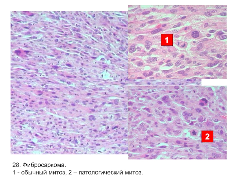 Фибросаркома микропрепарат рисунок