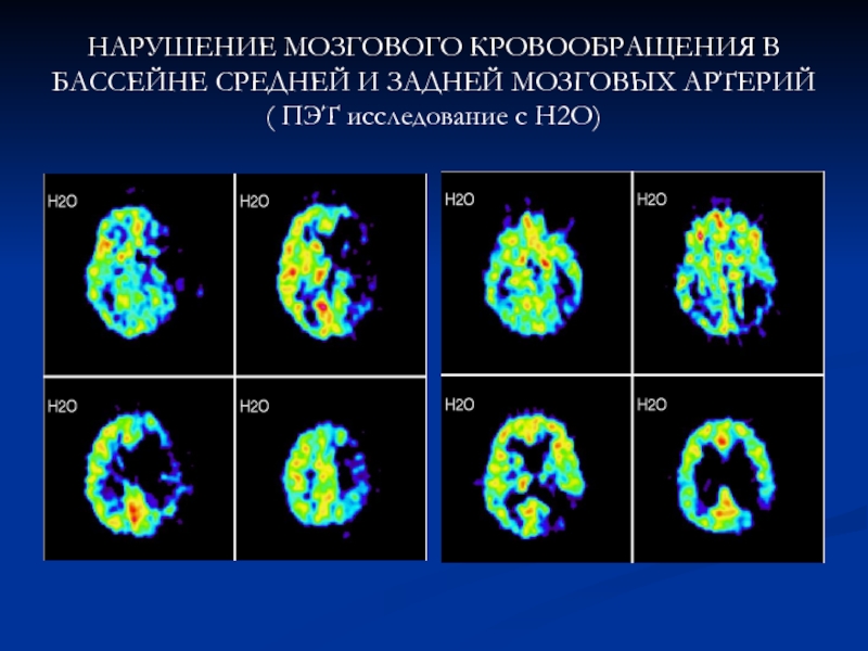 Исследование с 2 с. Нарушение кровообращения в бассейне средней мозговой артерии. Методы исследования мозгового кровообращения. Реверберация кровотока головного мозга. Проверка головного мозга при помощи электронов.