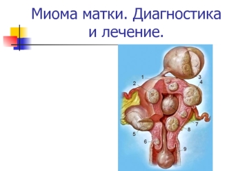 Миома матки. Диагностика и лечение