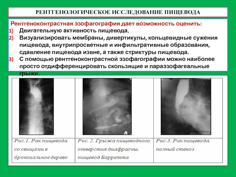 На основании сходной рентгенологической картины следует дифференцировать изменения пищевода при