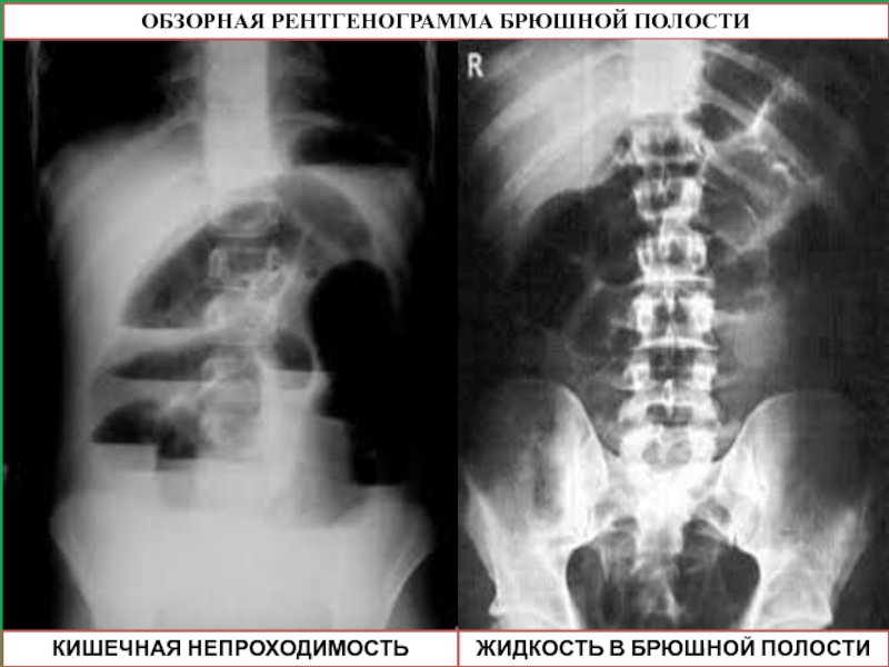 Обзорная рентгенография. Обзорная рентгенография брюшной полости ЖКБ. Обзорная рентгенограмма брюшной полости кишечная непроходимость. Обзорная рентгенография брюшной полости при кишечной непроходимости. Обзорная рентгенограмма при непроходимости.