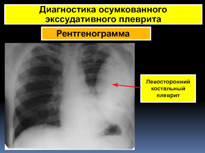 Рентгенологическая картина при экссудативном плеврите