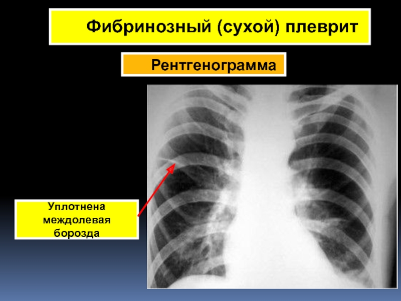 Сухой плеврит рентгенологическая картина