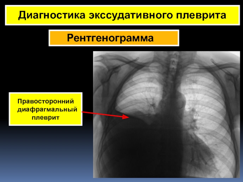 Экссудативный плеврит рентгенологическая картина