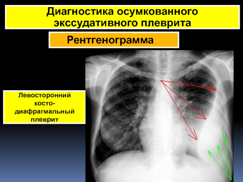 Рентгенологическая картина при экссудативном плеврите