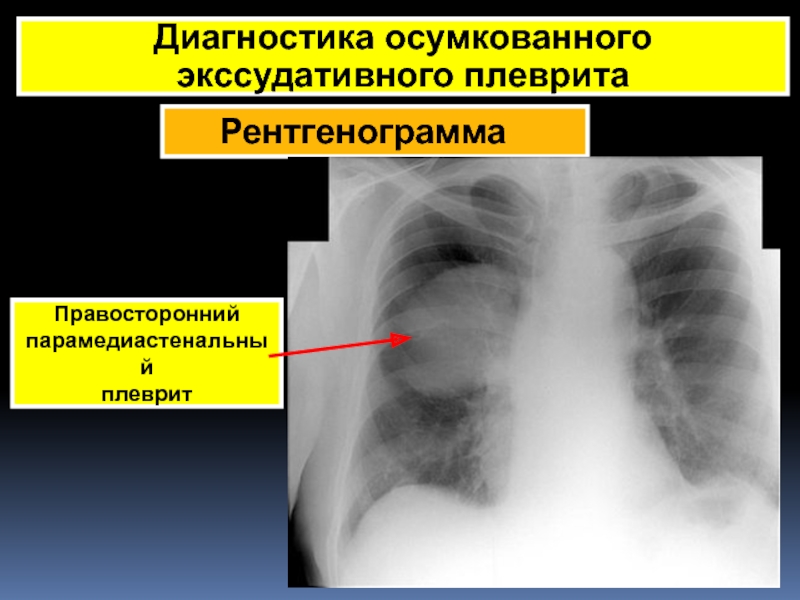 Рентгенологическая картина при экссудативном плеврите