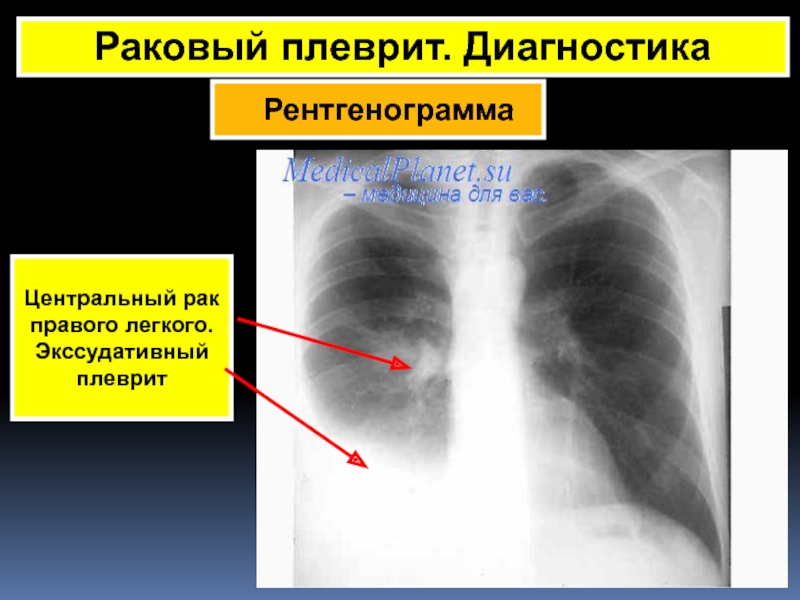 Питание при плеврите легкого картинки