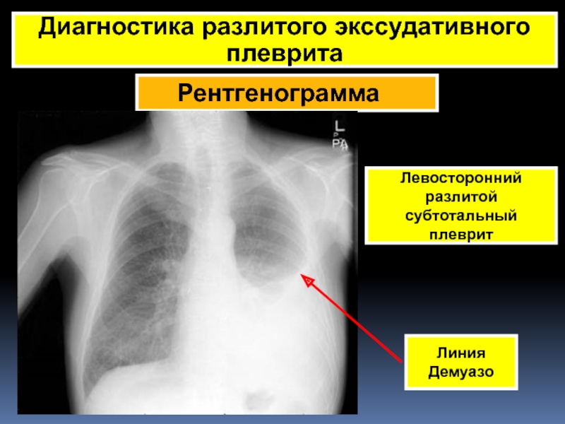 Экссудативный плеврит презентация