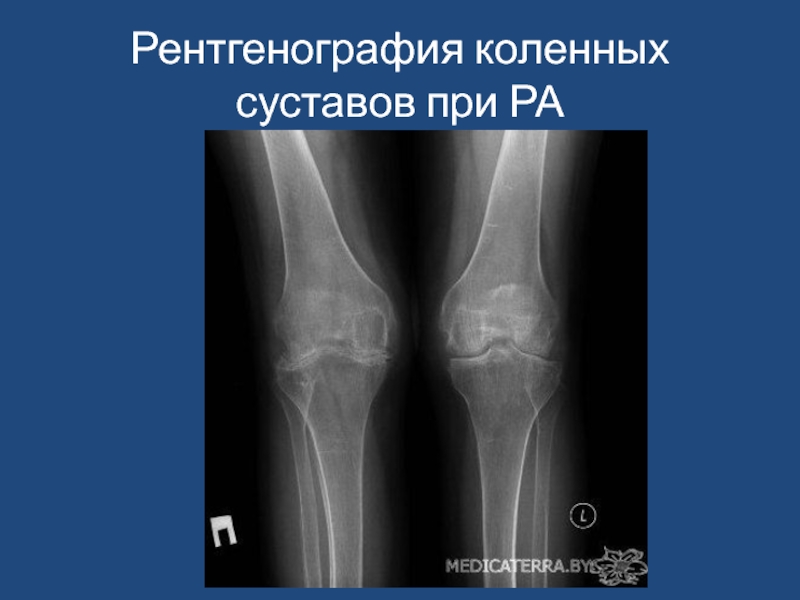 Ревматический полиартрит рентгенологическая картина