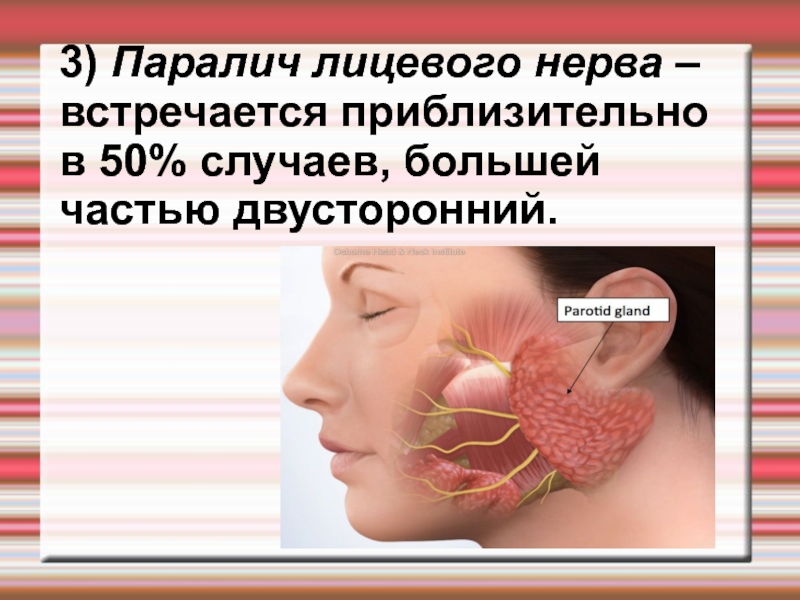 Центральный парез лицевого нерва. Двусторонний паралич лицевого нерва. Инсульт парез лицевого нерва.