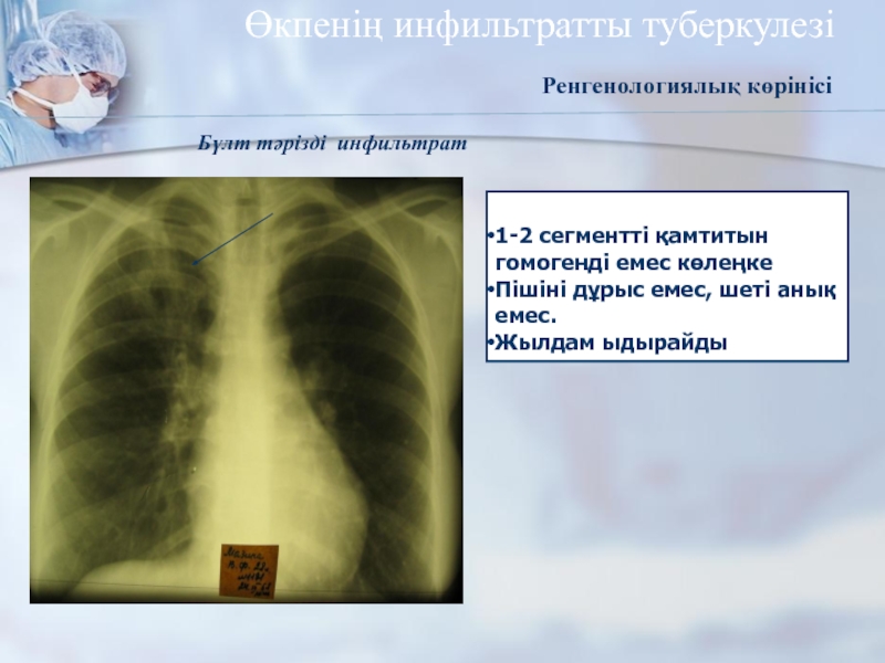 Размер инфильтрата