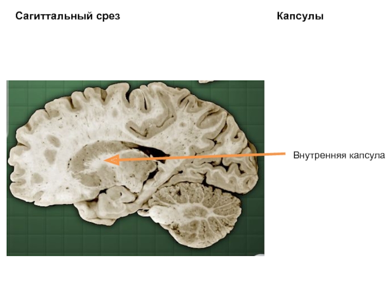 Что такое срез. Лучистый венец головного мозга. Внутренняя капсула на РКТ срез. Лучистый венец выбаратывает. 56. Крайняя капсула (конечный мозг).