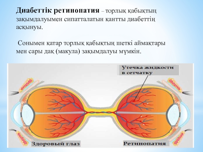 Диабеттік ретинопатия презентация