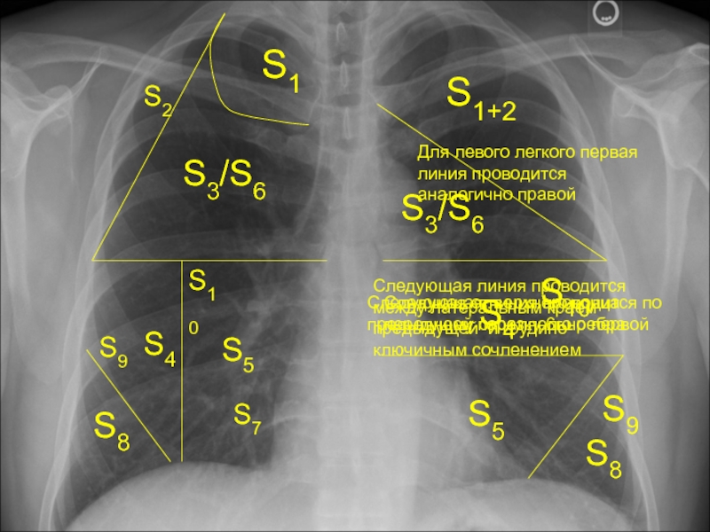 Рентген легких схема