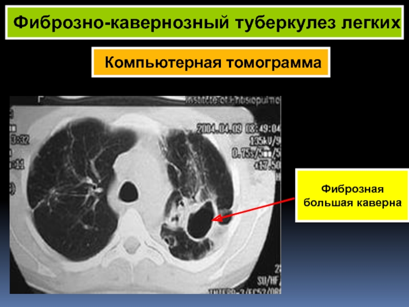 Картина кт при туберкулезе