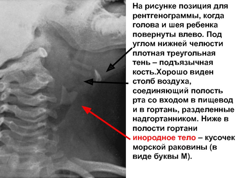 Шиловидный отросток подъязычной кости фото